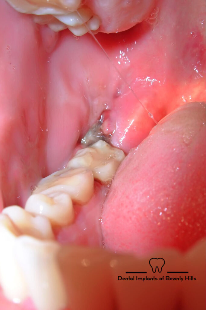 abscess tooth removal