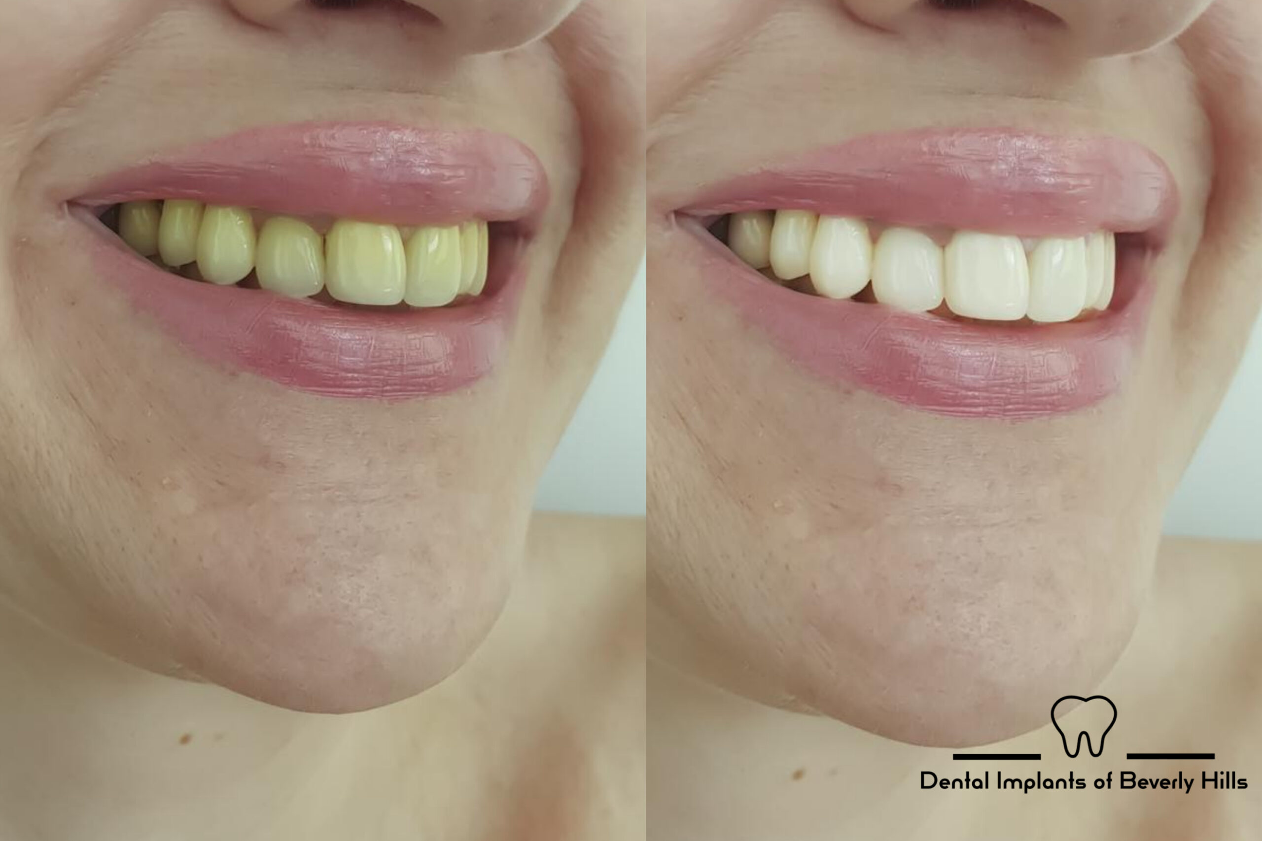 before and after picture of smile makeover