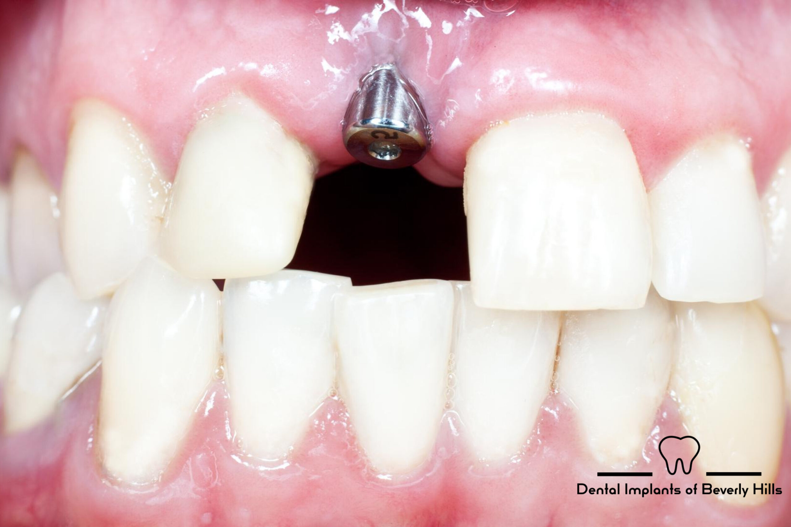 titanium rod inserted for dental implant and missing tooth