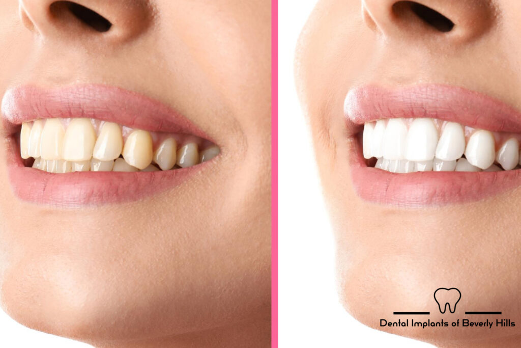 Restored smile after full mouth restoration procedure