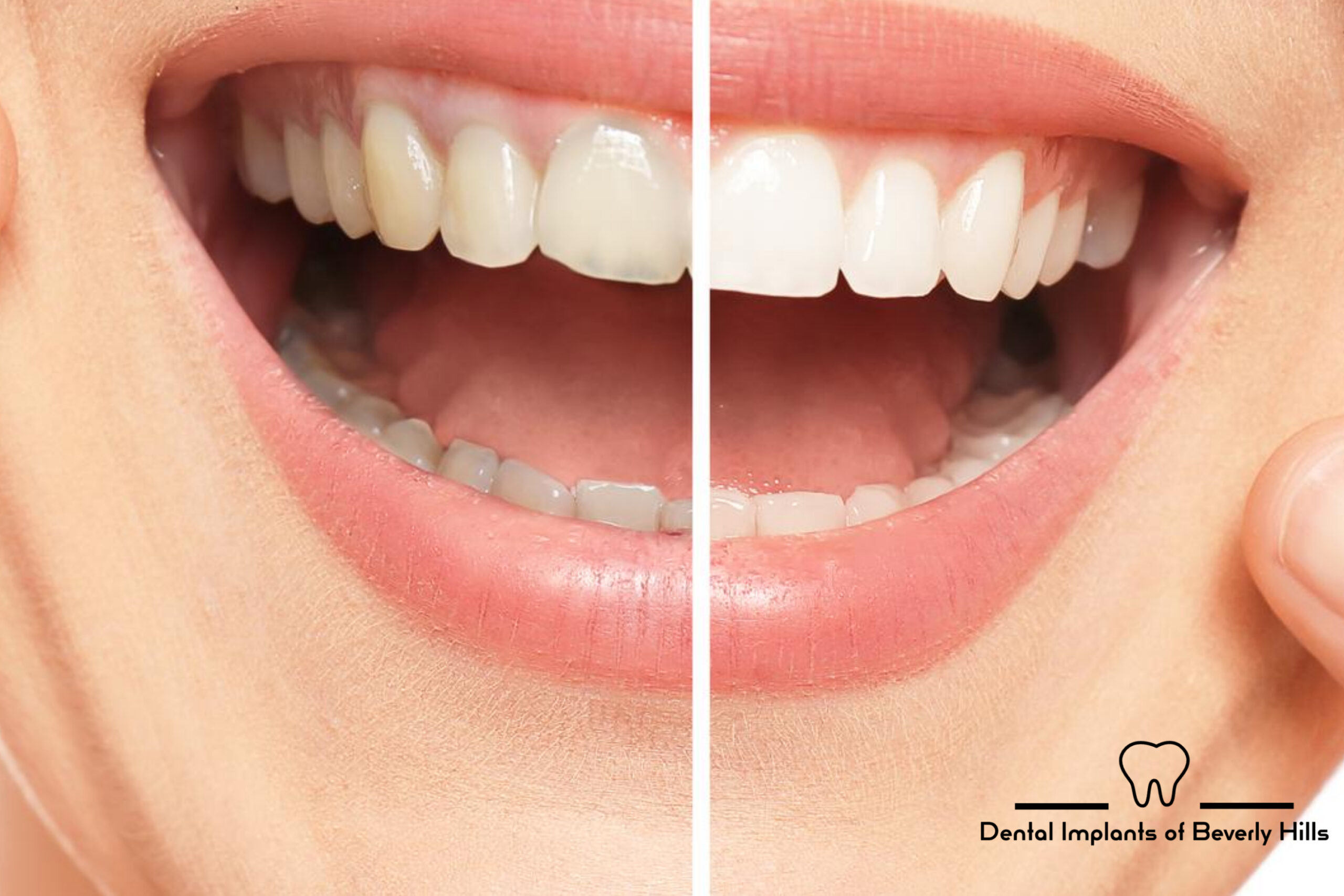picture of a woman smiling before and after smile restoration treatment